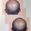 3PCS/Pack Scalp Micropigmentation Practice Skin – Printed SMP Tattoo Training