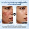 Ácido Azelaico Crema Con 20% Vitamina C Y Niacinamida