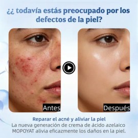 Ácido Azelaico Crema Con 20% Vitamina C Y Niacinamida