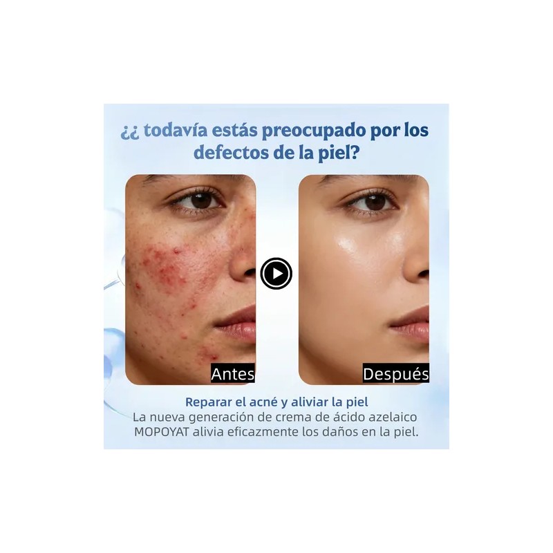 Ácido Azelaico Crema Con 20% Vitamina C Y Niacinamida