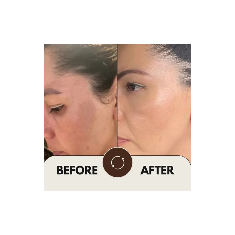 Crema Aclaradora Y Loción Quita Paño Manchas Acné Sol