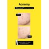 ZITCONTROL® - All-in-one treatment for acne-prone skin