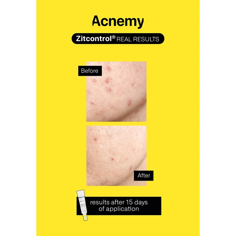 ZITCONTROL® - All-in-one treatment for acne-prone skin