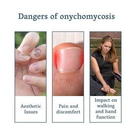 DMQ Fungel Nail Treatmet for Toenails - Extra Strong Nail Fungas Treatmet for Toenail and Fingernail- Antifungas Nail Repeir for Thick, Broken, Discolored Nails - Fast-Acting Nail Growth Formula