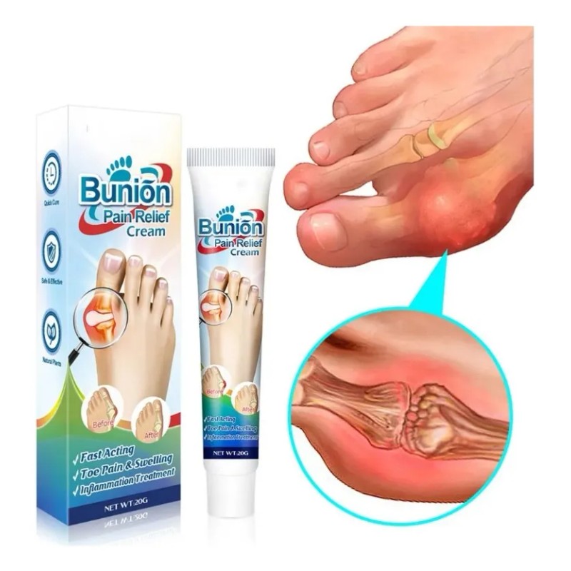 2 Pomadas Para El Dolor De Juanetes En L, Pomada