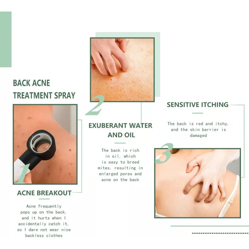 Ia Aj Cura El Acné De Espalda Con Ácido Salicílico