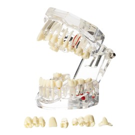 Modelo de tipodonto oral dental implante patológico extraíble enseñar demostración de anatomía visible tamaño estándar (transparente)