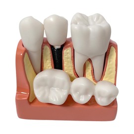 GOLICC Dental Implant Demonstration Model 4X Removable Crown Bridge | Teeth Analysis Model for Dental Education, Student Study & Clinical Training | Durable Acrylic Base