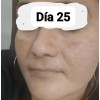 Crema Despigmentante De Paño Melasma Acne