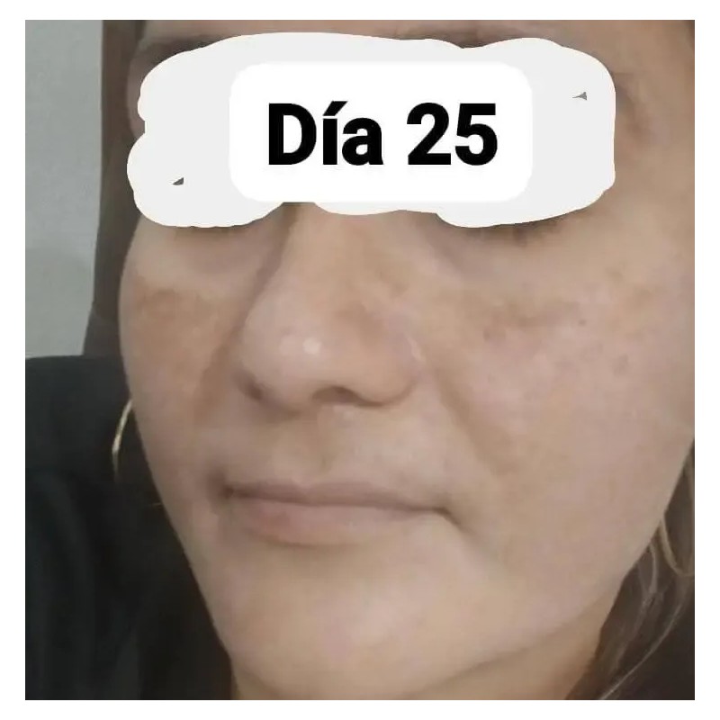Crema Despigmentante De Paño Melasma Acne