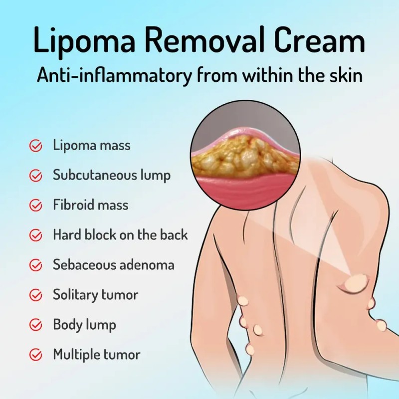 Jx Crema Limpiadora Para Lipomas Nc4c, Bloqueadora Grasa, 1