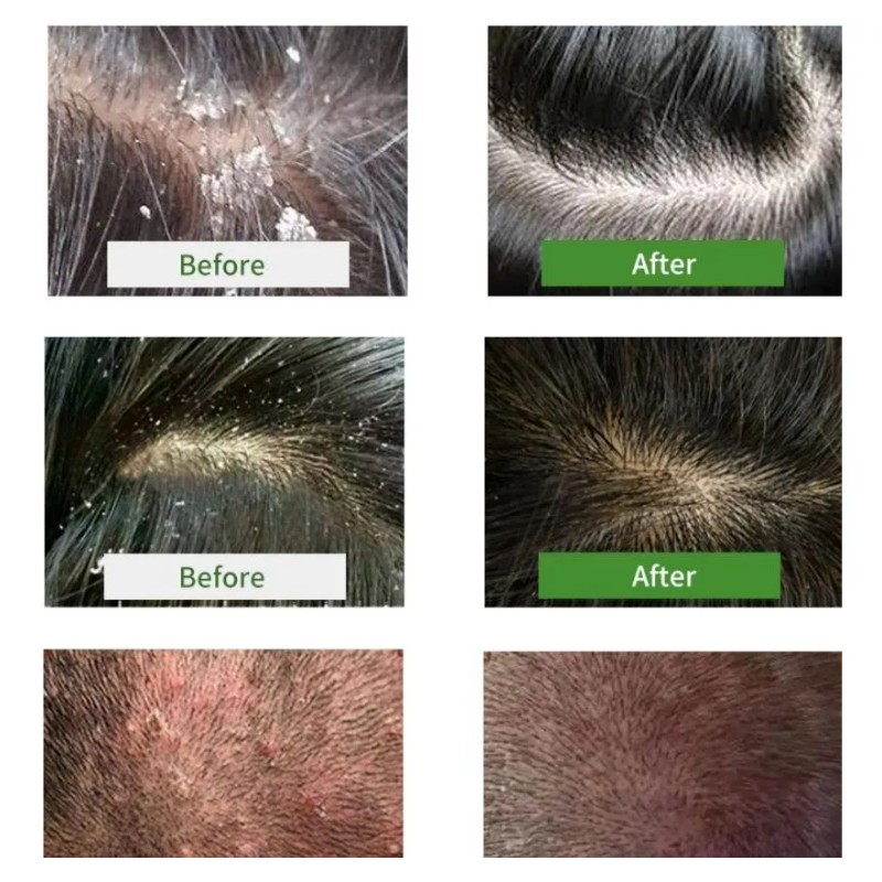 Shampoo Alquitrn D Hulla Control Psoriasis Caspa 1 Litro