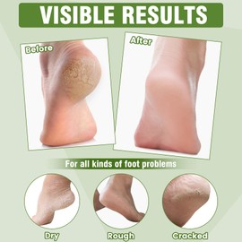 18 Pairs Moisturizing Foot Masks with Shea Butter, Jojoba Oil, Vitamin E & Urea, Intensely Hydrating Foot Mask For Dry Cracked Feet, Moisturizing Socks for Cracked Heel Treatment