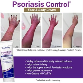 TriDerma “Crema Facial Y Corporal Para El Control De La Psoriasis, 4.2 Onzas, Paquete De 4