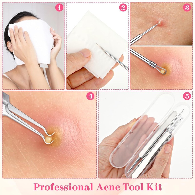 5PCS Blackhead Remover Comedone Extractor,Stainless Pimple Popper Tool，Curved Blackhead Tweezers
