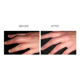 Scarfade Gel De Cicatrices De Silicona Para Reparacin De Cic