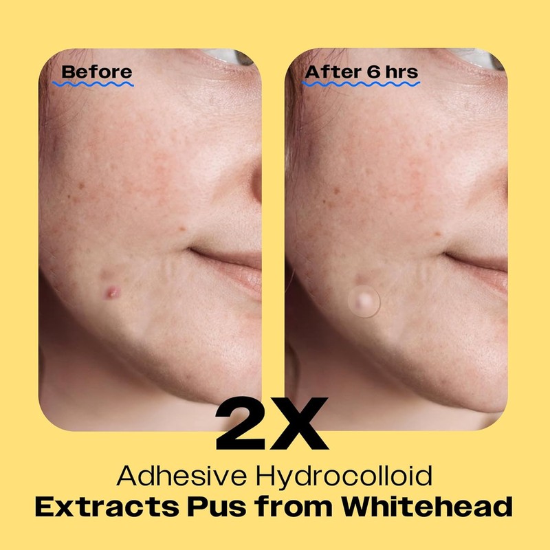  AVARELLE Cover Patch Hydrocolloid, Tea Tree, Calendula, Rosehip Oil