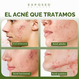 Clear Pore Serum by Exposed Skin Care, eliminate White-Heads and Black-Heads; Salicylic Acid 1%, 1.7 ounces