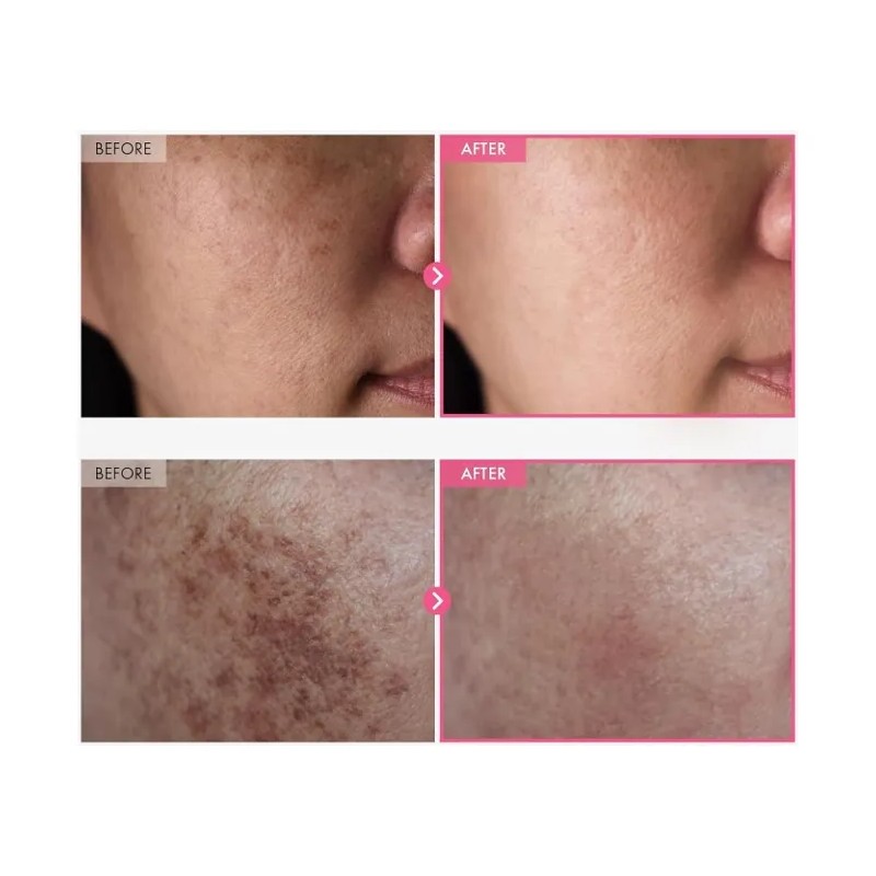 Crema Despigmentante Arbutin Tranexámico 50ml Piezas Normal Día Noche