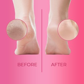 CUTIKLES CUTIKLES Professional Callus Remover Gel for Feet – Extra Strength Gel Instantly Removes Tough Calluses for Spa-Quality Pedicures at Home. Convenient Travel-Friendly Pack - 1 Fl Oz