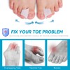 Nolimvita Hammer Toe Straightener Corrector - Toe Spacers Toe Splints
