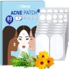 LitBear Large Acne Pimple Patches, 5 Sizes 80 Patches 80 Count (Pack of 1)