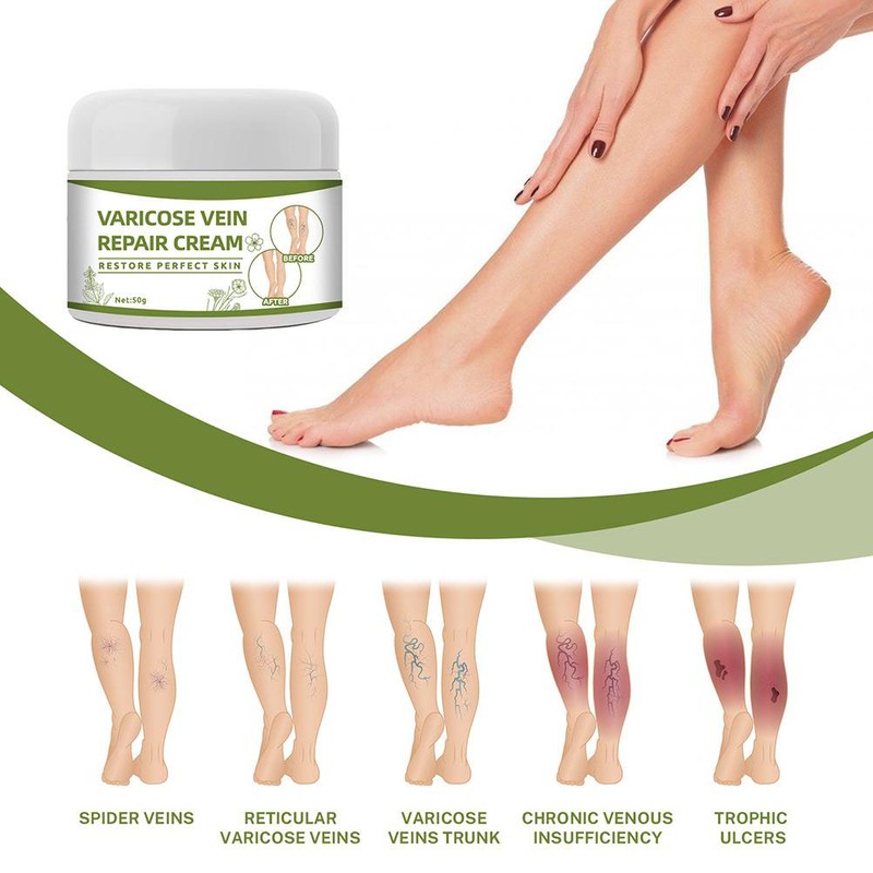 Varicose Veins Cream Natural Ointment for Varicose and Spider Veins
