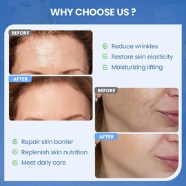 Okela Forehead Wrinkle Patches & Smile Line Patches Overnight, Hydrogel Smoothing Patches Skin Care Gifts for Fine Lines, Deep Line and Firming