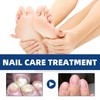 20ml Nail Treatment,Nail Treatment for Toenail Fingernails,Toenai-ls Extra Strong N-ail