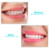 20 Pieces Aligner Tray Seaters for Aligner Trays Chompers Orthodontic
