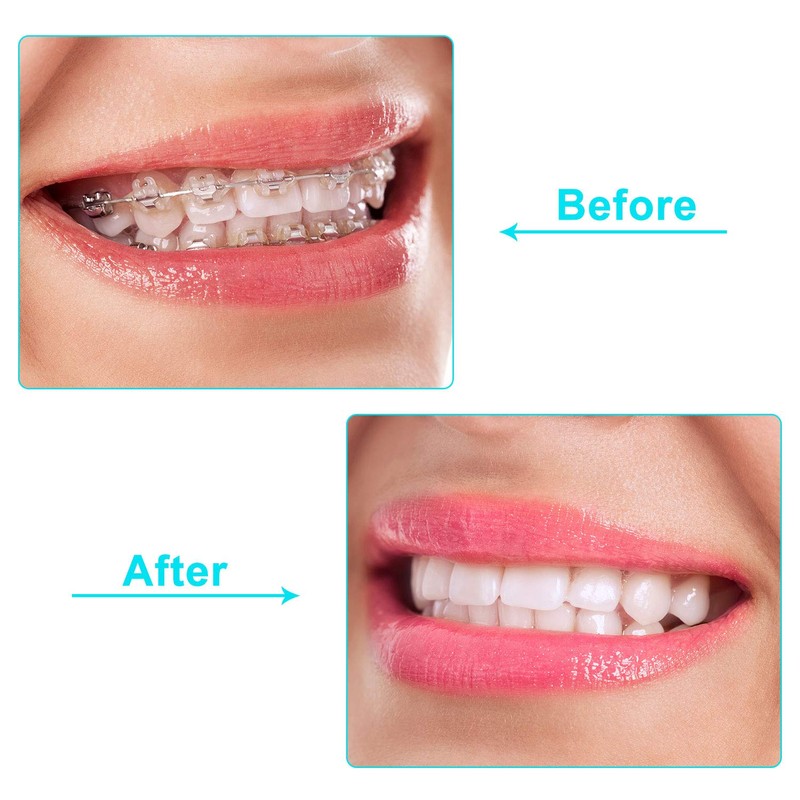 20 Pieces Aligner Tray Seaters for Aligner Trays Chompers Orthodontic