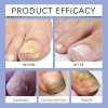 Tratamiento De Uñas De Los Pies Para Mujeres, Extractos De