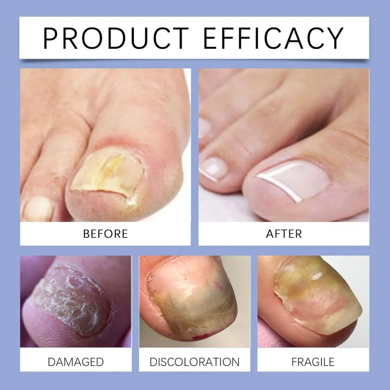 Tratamiento De Uñas De Los Pies Para Mujeres, Extractos De