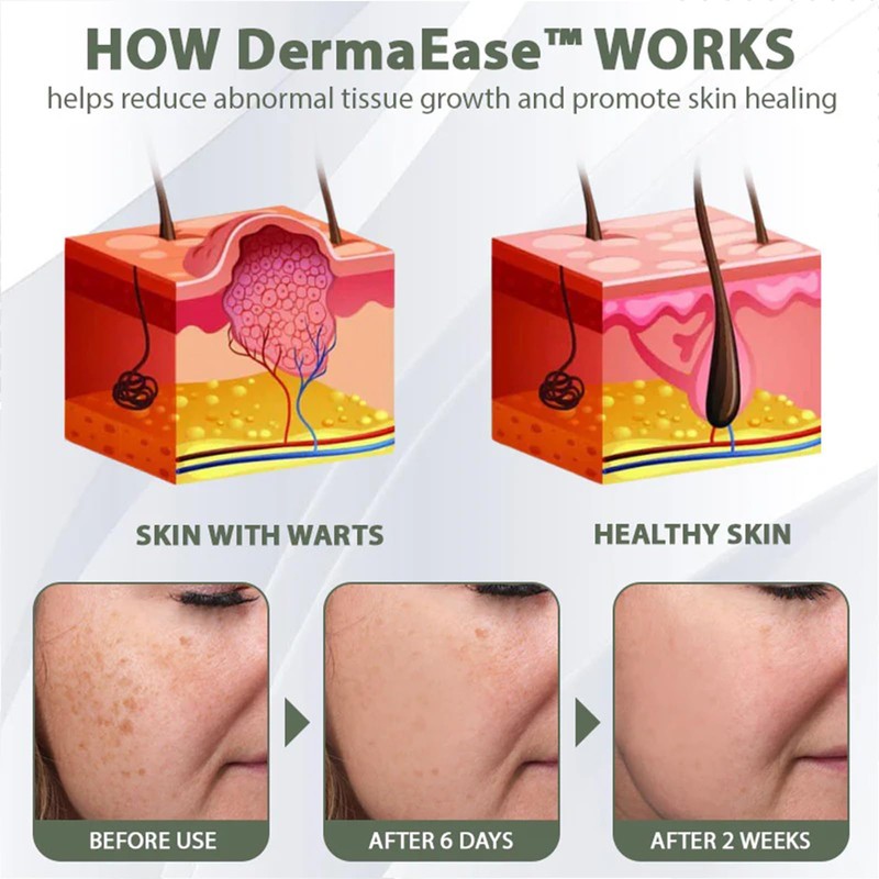 Luhaka Luhaka DermaEase Natureerase Instant Mole Spot Removal Gel,Purifying gel