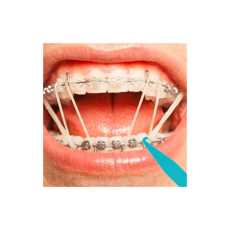 30 bandas elásticas dentales multicolor para tirantes, de plástico, desechables,