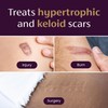 Mederma Large Medical Grade Silicone Scar Sheets; Improves The Appearance