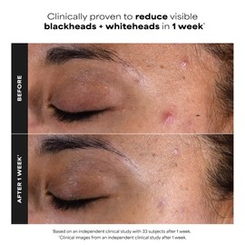 Paula's Choice SKIN PERFECTING 2% BHA Salicylic Acid Exfoliating Pads - Facial Exfoliant Pads for Blackheads, Enlarged Pores, Wrinkles & Fine Lines, 10 ct