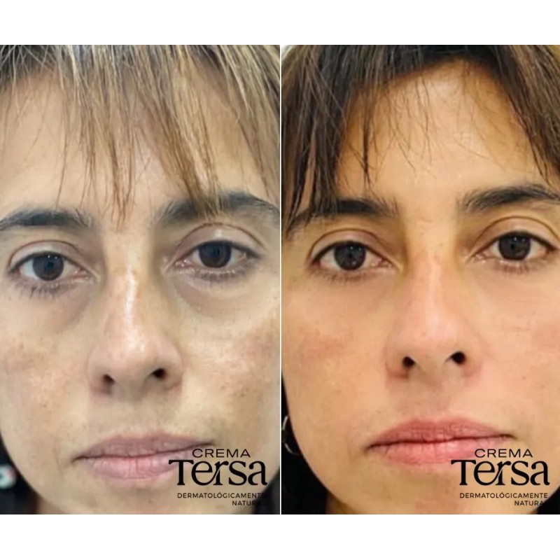 Crema Tersa Despigmentante Quita Manchas Acné Paño De 50g
