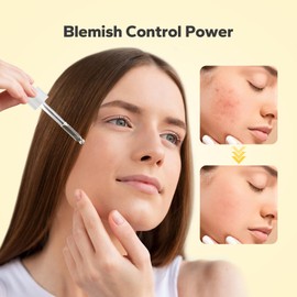 SilkySecret 10% Azelaic Acid Serum (1 Fl Oz), Niacinamide Infused Skin Care for Face, Pore Minimizing, Redness Relief, Reduce Cystic Acne Scar, Blemish Control Serum