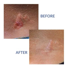 Xeragel 100% De Silicona Cicatriz Tratamiento Ungüento - Clí