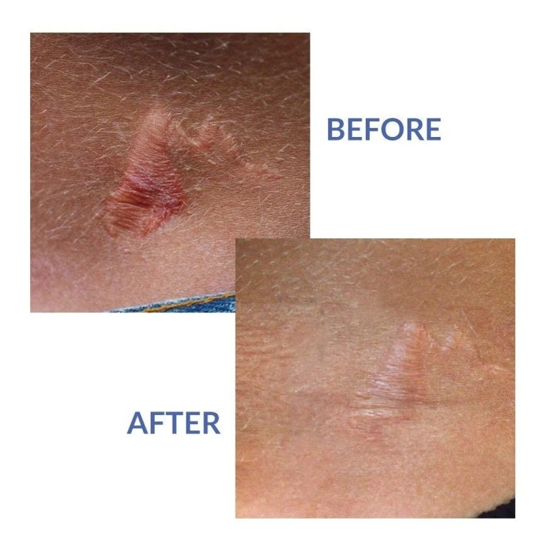 Xeragel 100% De Silicona Cicatriz Tratamiento Ungüento - Clí