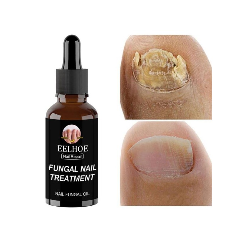 손톱 에센스 리페어 발톱 [9] Nail Essence Repair Toe Nails