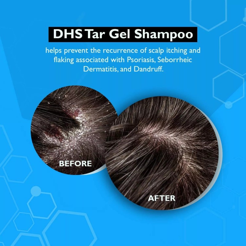 DHS TAR SHAMPOO Anti Dandruff, Psoriasis, Coal Tar GEL 8