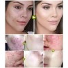 Tratamiento Acne Puntos Negros Manchas Cicatrices Barros 2pz