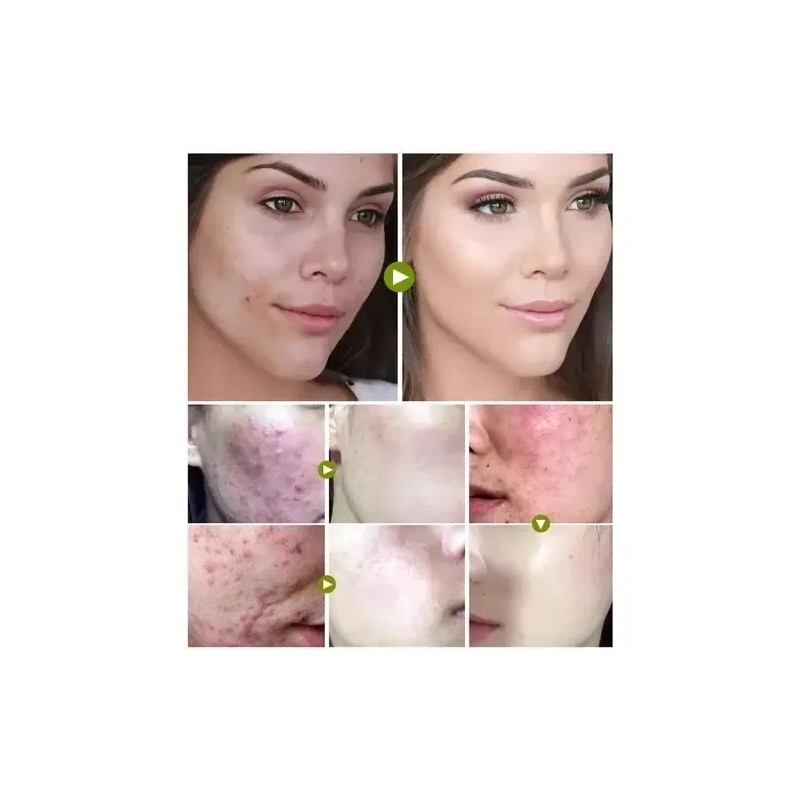 Tratamiento Acne Puntos Negros Manchas Cicatrices Barros 2pz