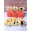 Tankredrug 4 Times Caries Evolution Model Detachable Teeth Disease Teach