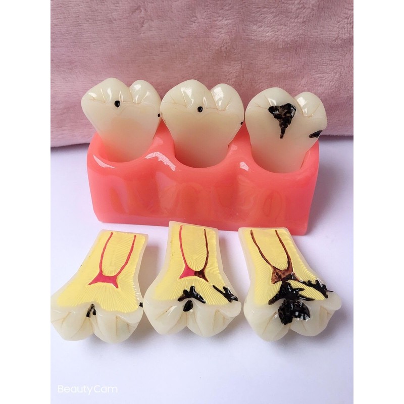 Tankredrug 4 Times Caries Evolution Model Detachable Teeth Disease Teach