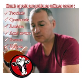 Crema Sana Psoriasis Quemaduras Eccema Herpes Rosácea Tallow