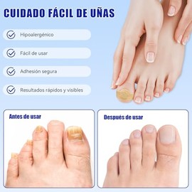 Parches de Cuidado para las Uñas，Parches Correctores para las Uñas de los Pies,PatchesIngredientes Naturales, Mejorar la Apariencia de las Uñas