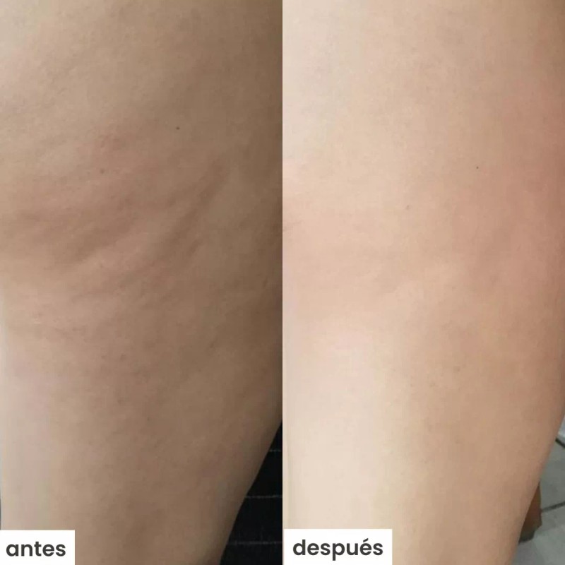 Azala Natura Kit Azala Natura Con Ventosa (celulitis)